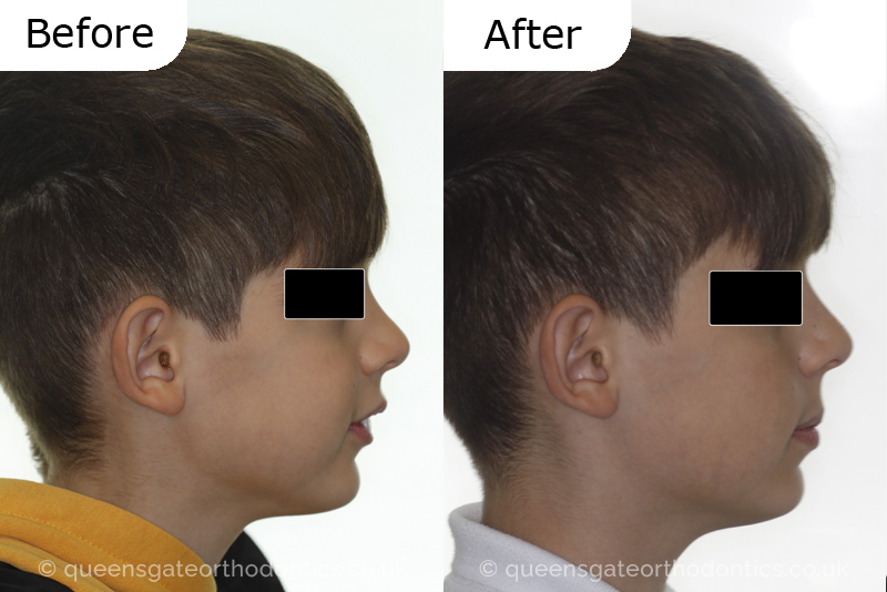 Large overjet due to short lower jaw, causing lower lip trapping and proclination of the upper incisors