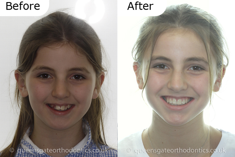 Orthodontic treatment