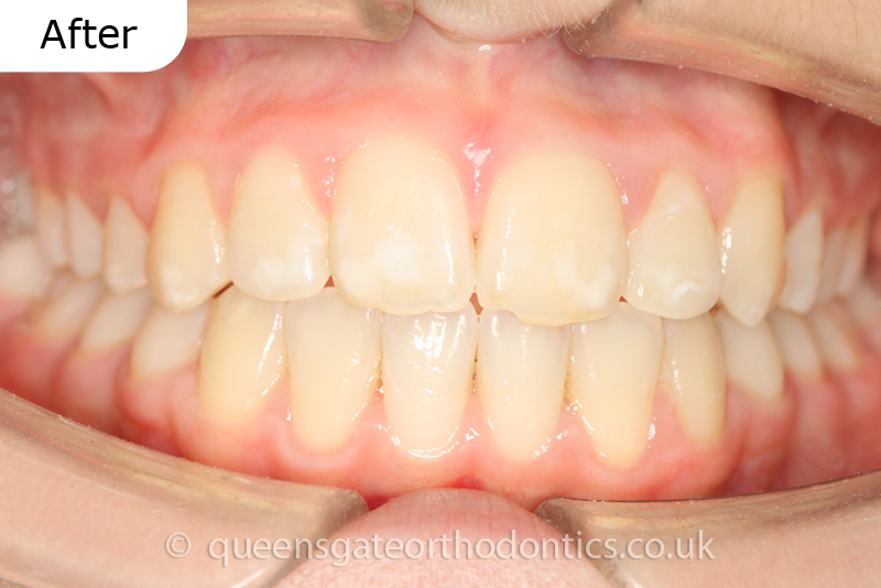 Orthodontic treatment