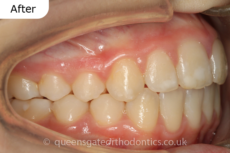 Orthodontic treatment