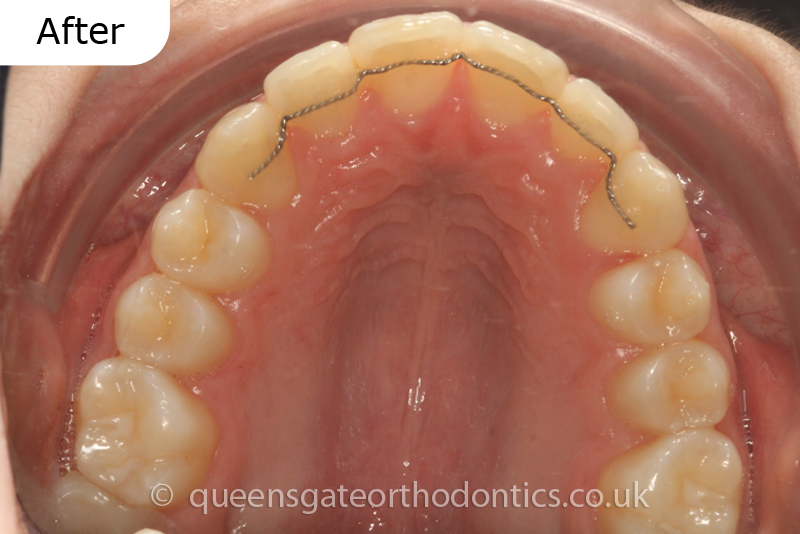 Orthodontic treatment