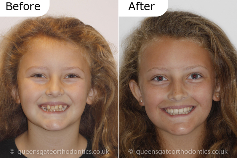 Orthodontic treatment