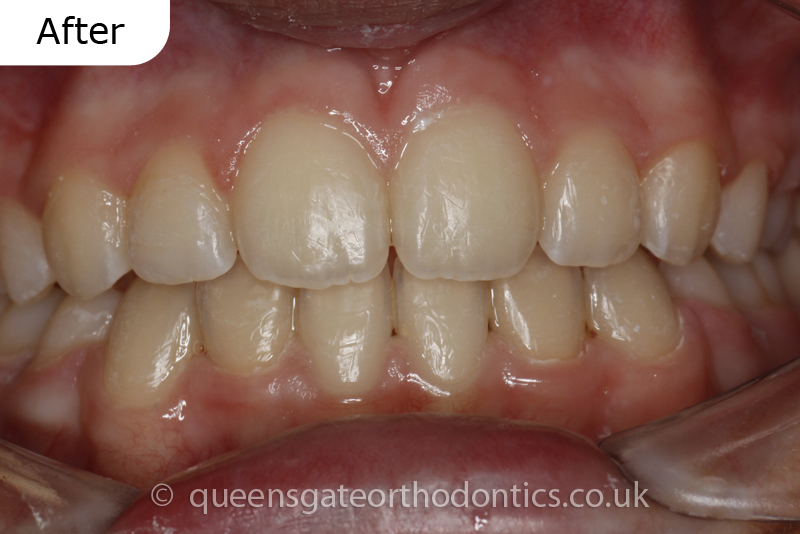 Orthodontic treatment