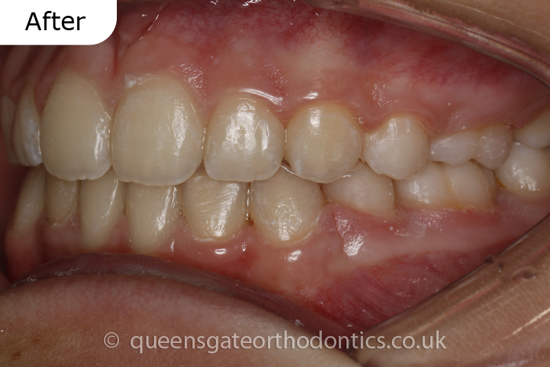 Orthodontic treatment