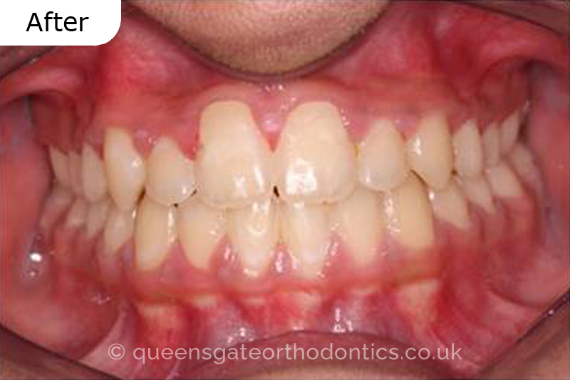 Correction of severely crowded teeth