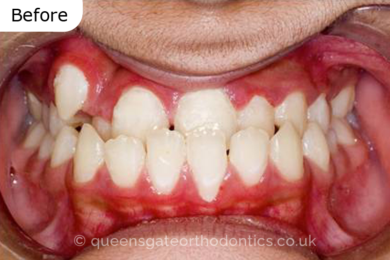 Correction of severely crowded teeth