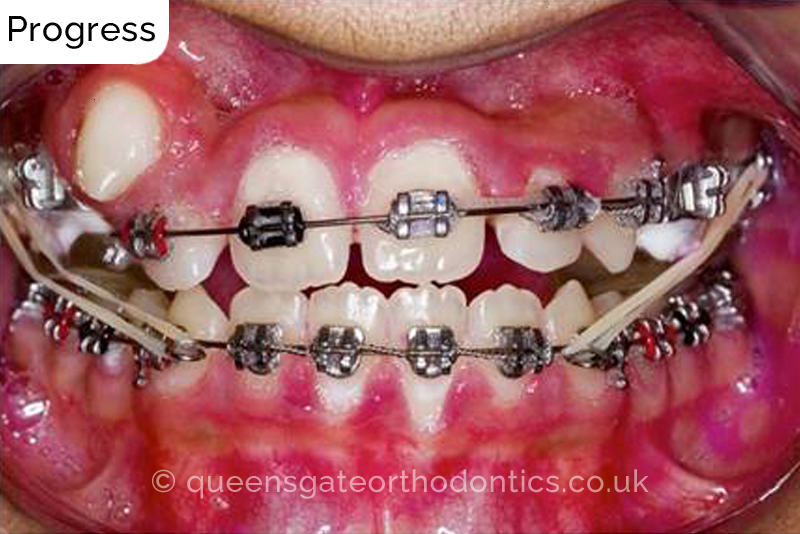 Correction of severely crowded teeth