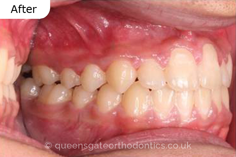 Correction of severely crowded teeth