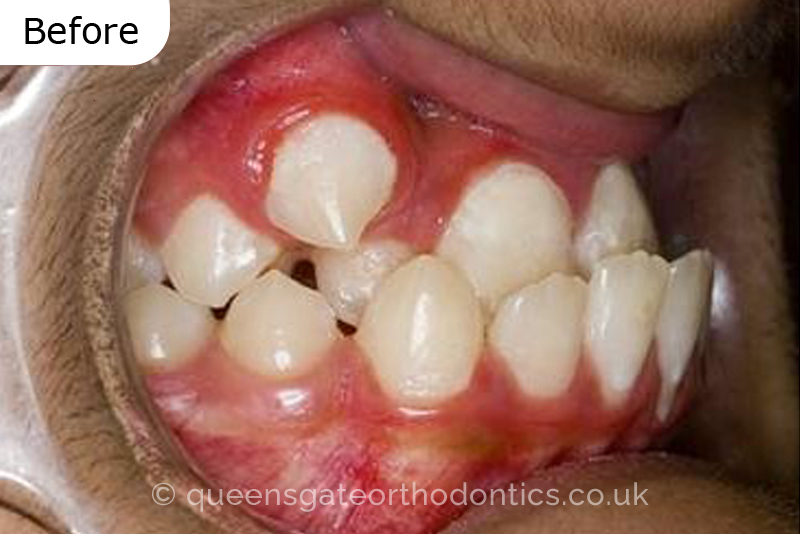 Correction of severely crowded teeth