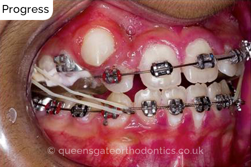 Correction of severely crowded teeth