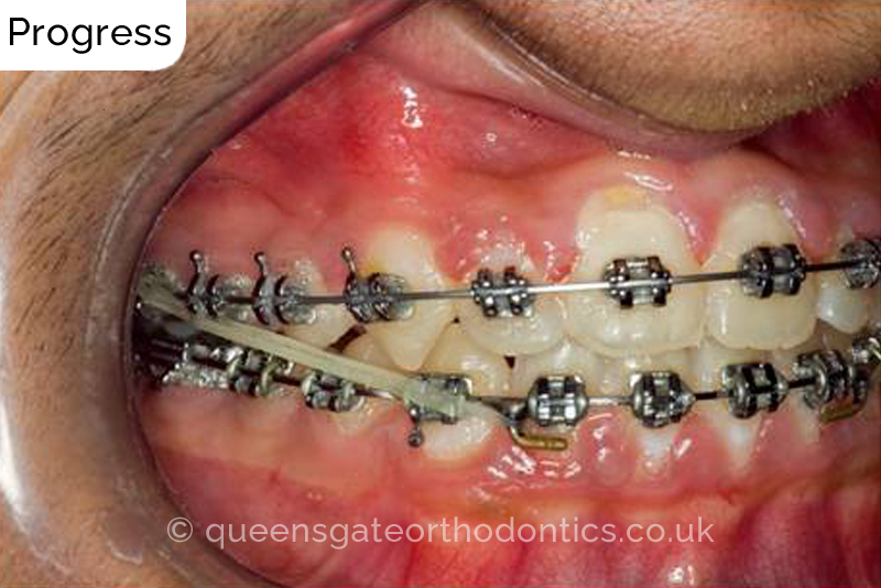 Correction of severely crowded teeth