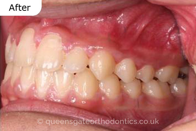 Correction of severely crowded teeth