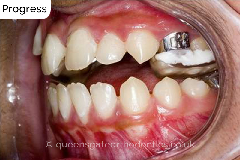 Correction of severely crowded teeth
