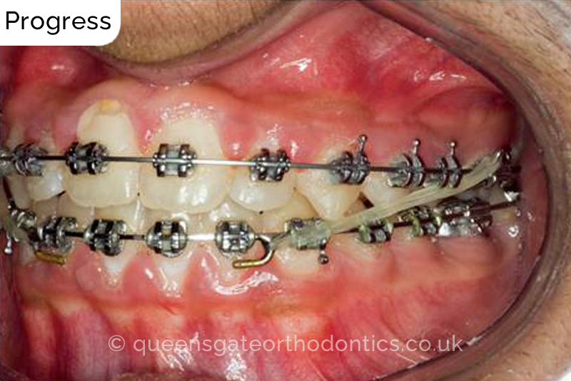 Correction of severely crowded teeth