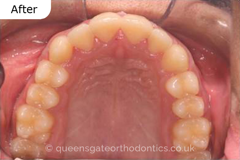 Correction of severely crowded teeth