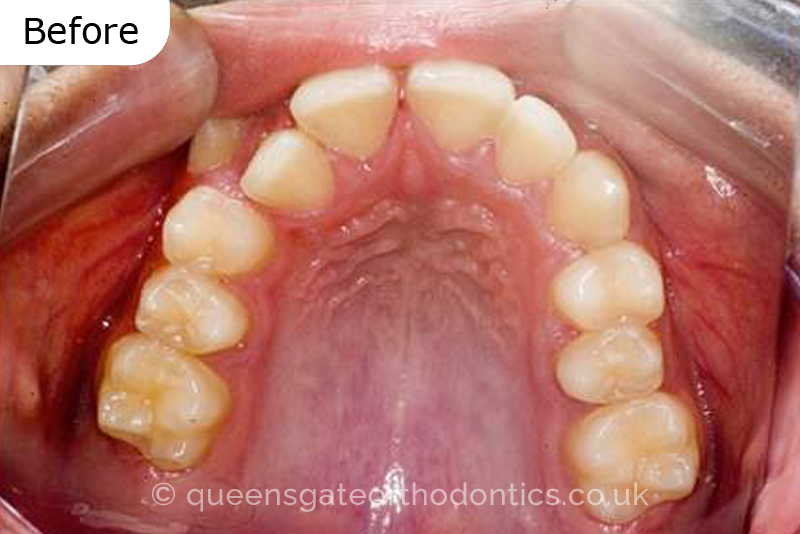 Correction of severely crowded teeth