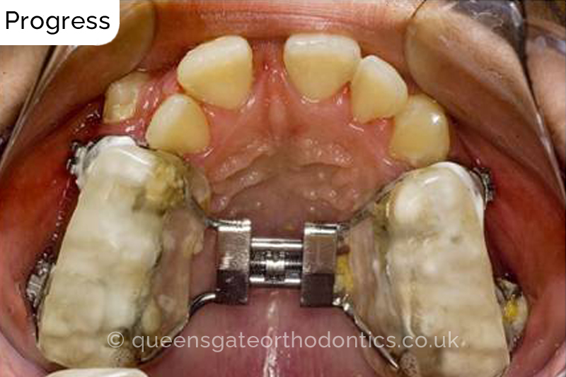 Correction of severely crowded teeth