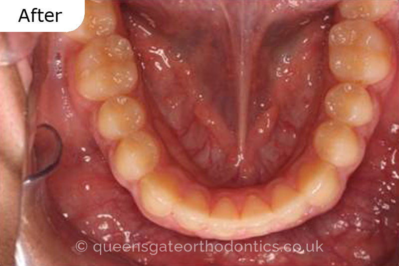 Correction of severely crowded teeth