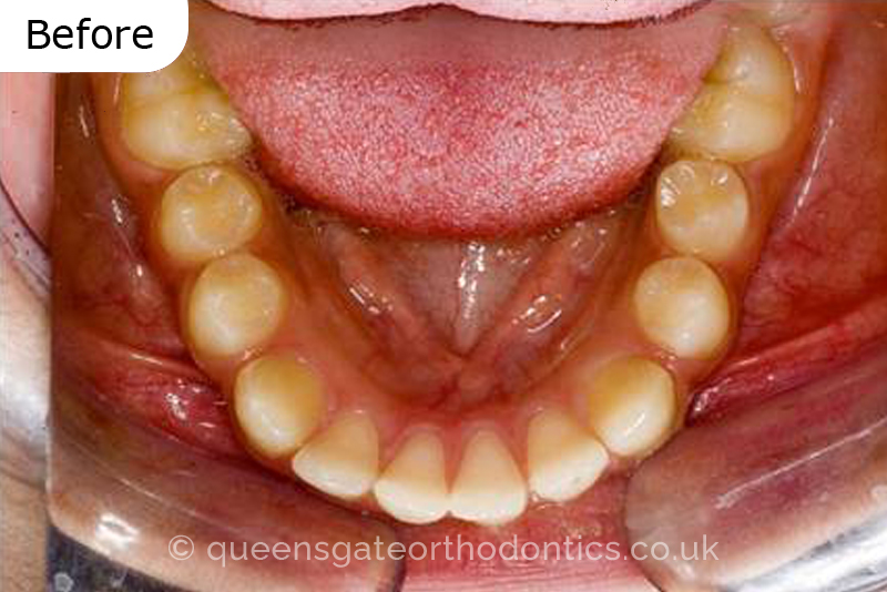 Correction of severely crowded teeth