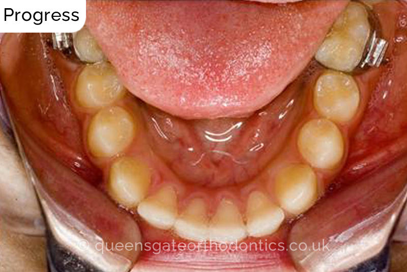 Correction of severely crowded teeth