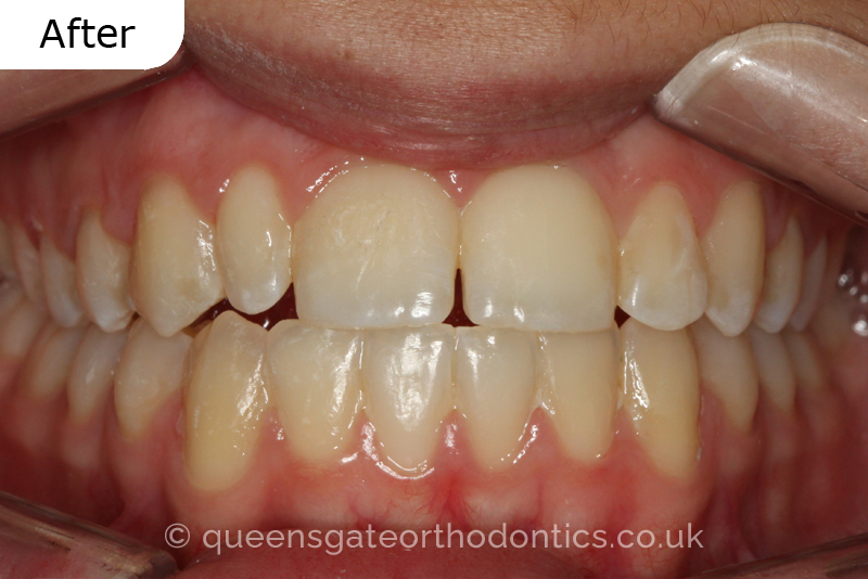 Correction of a palatally positioned, severely impacted adult canine (non – extraction), crowded lower incisors and a class III malocclusion (non – extraction)