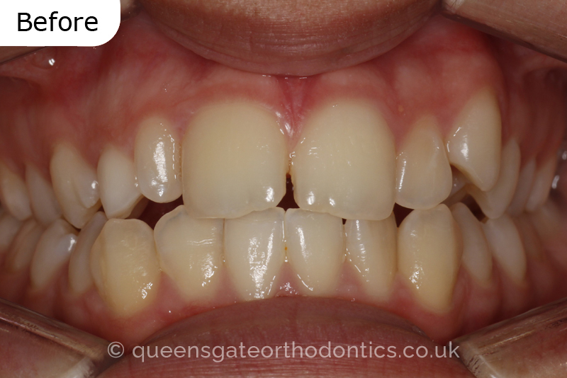 Correction of a palatally positioned, severely impacted adult canine (non – extraction), crowded lower incisors and a class III malocclusion (non – extraction)