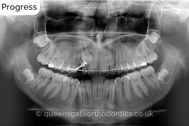 Correction of a palatally positioned, severely impacted adult canine (non – extraction), crowded lower incisors and a class III malocclusion (non – extraction)