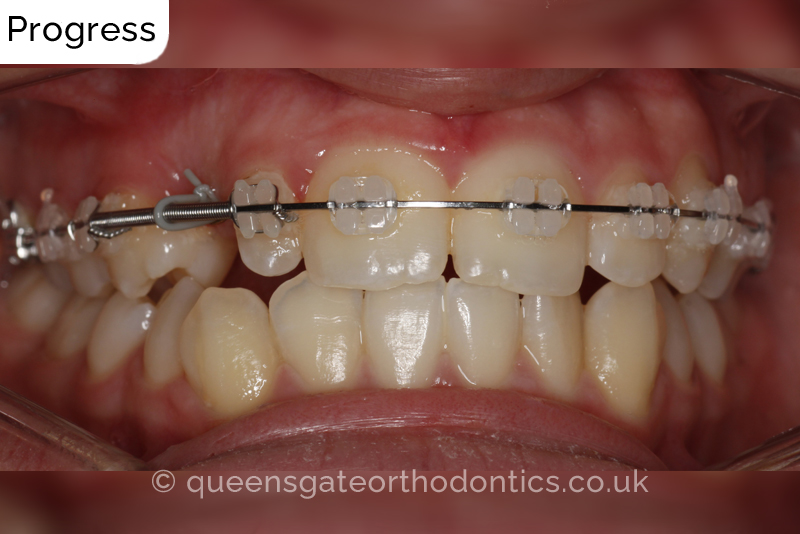 Correction of a palatally positioned, severely impacted adult canine (non – extraction), crowded lower incisors and a class III malocclusion (non – extraction)