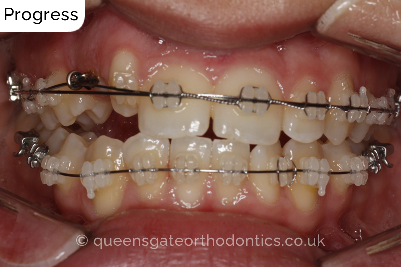 Correction of a palatally positioned, severely impacted adult canine (non – extraction), crowded lower incisors and a class III malocclusion (non – extraction)