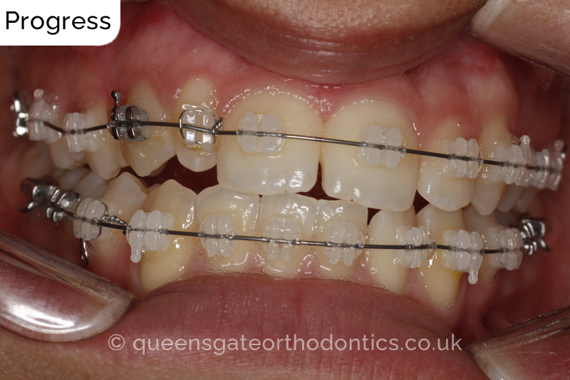 Correction of a palatally positioned, severely impacted adult canine (non – extraction), crowded lower incisors and a class III malocclusion (non – extraction)