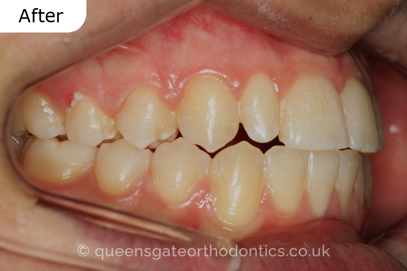 Correction of a palatally positioned, severely impacted adult canine (non – extraction), crowded lower incisors and a class III malocclusion (non – extraction)