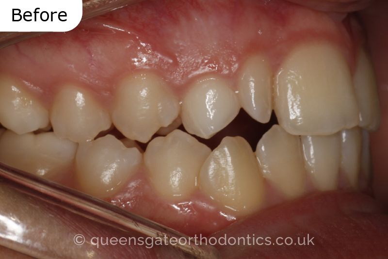 Correction of a palatally positioned, severely impacted adult canine (non – extraction), crowded lower incisors and a class III malocclusion (non – extraction)