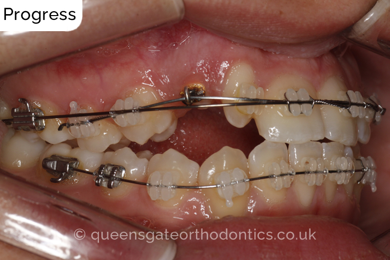 Correction of a palatally positioned, severely impacted adult canine (non – extraction), crowded lower incisors and a class III malocclusion (non – extraction)