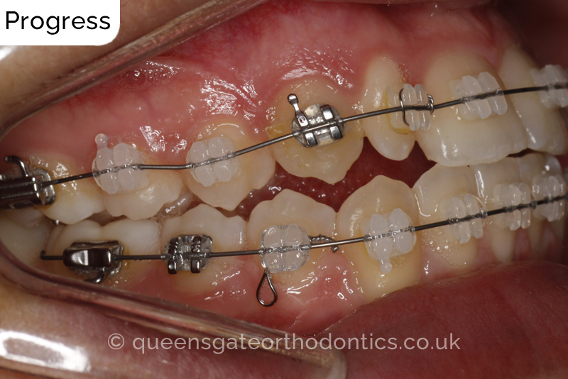 Correction of a palatally positioned, severely impacted adult canine (non – extraction), crowded lower incisors and a class III malocclusion (non – extraction)