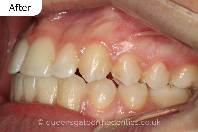 Correction of a palatally positioned, severely impacted adult canine (non – extraction), crowded lower incisors and a class III malocclusion (non – extraction)