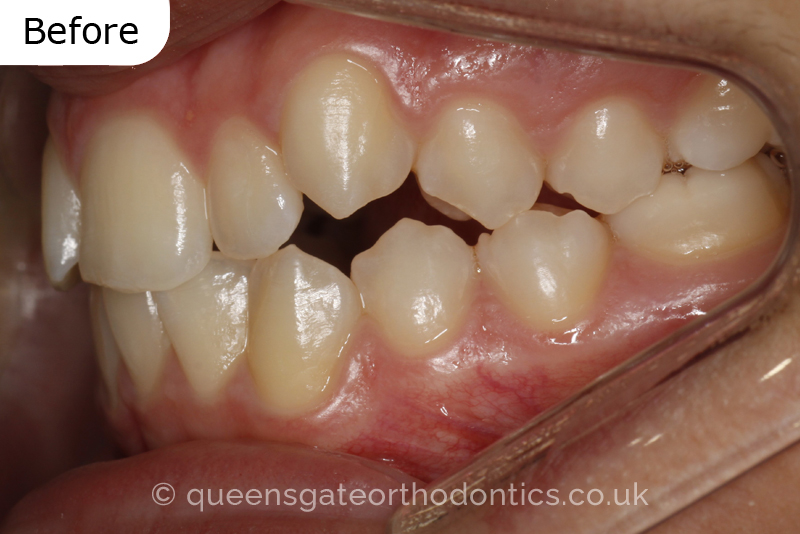 Correction of a palatally positioned, severely impacted adult canine (non – extraction), crowded lower incisors and a class III malocclusion (non – extraction)