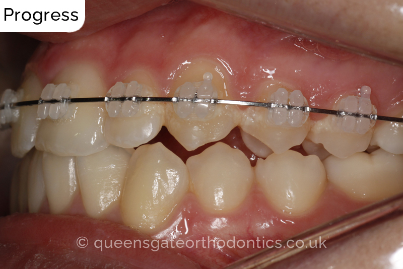 Correction of a palatally positioned, severely impacted adult canine (non – extraction), crowded lower incisors and a class III malocclusion (non – extraction)