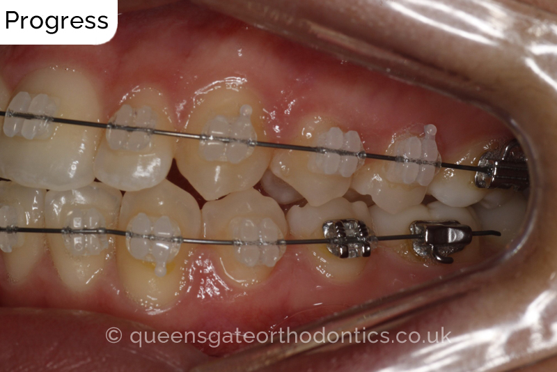 Correction of a palatally positioned, severely impacted adult canine (non – extraction), crowded lower incisors and a class III malocclusion (non – extraction)