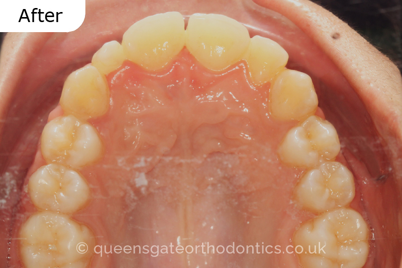 Correction of a palatally positioned, severely impacted adult canine (non – extraction), crowded lower incisors and a class III malocclusion (non – extraction)