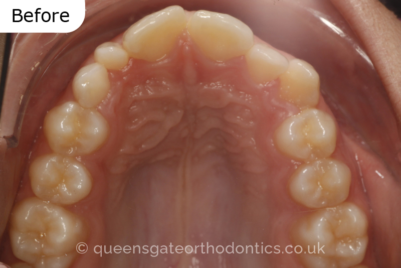 Correction of a palatally positioned, severely impacted adult canine (non – extraction), crowded lower incisors and a class III malocclusion (non – extraction)