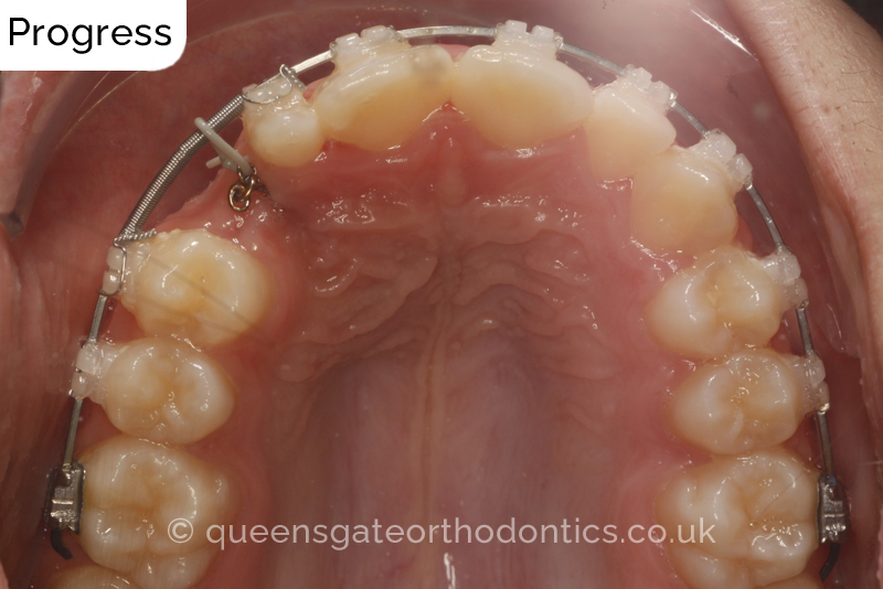 Correction of a palatally positioned, severely impacted adult canine (non – extraction), crowded lower incisors and a class III malocclusion (non – extraction)