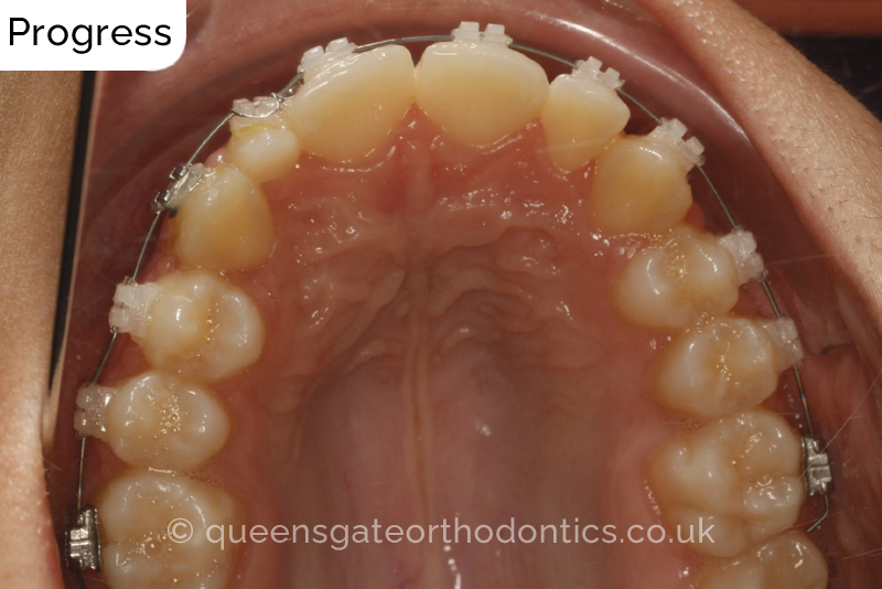 Correction of a palatally positioned, severely impacted adult canine (non – extraction), crowded lower incisors and a class III malocclusion (non – extraction)