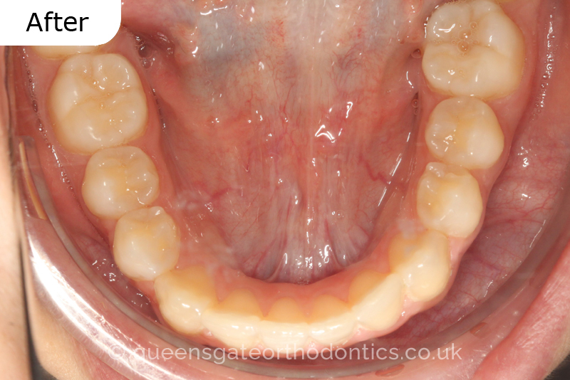 Correction of a palatally positioned, severely impacted adult canine (non – extraction), crowded lower incisors and a class III malocclusion (non – extraction)