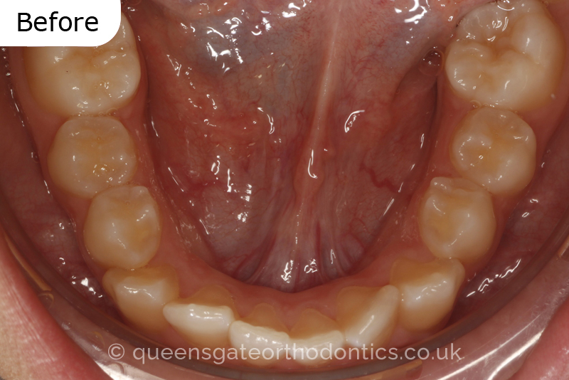 Correction of a palatally positioned, severely impacted adult canine (non – extraction), crowded lower incisors and a class III malocclusion (non – extraction)