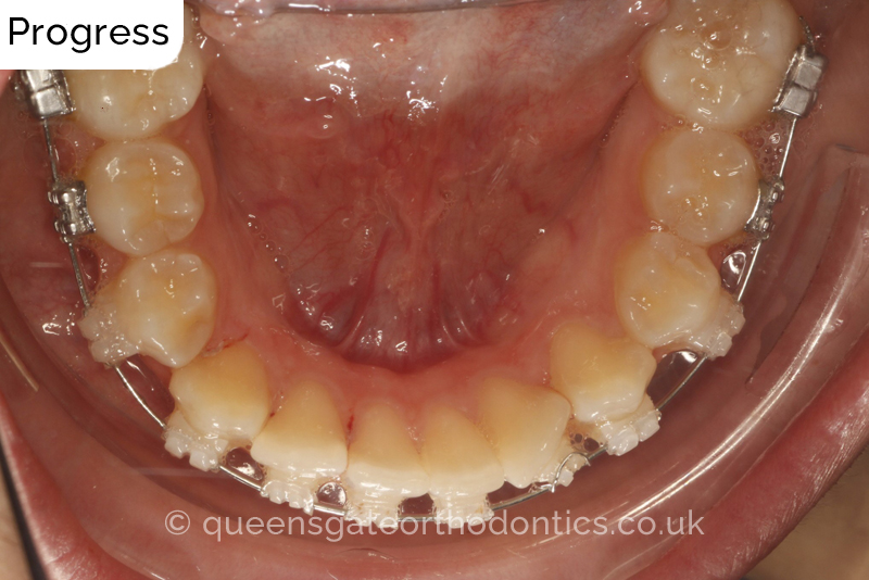 Correction of a palatally positioned, severely impacted adult canine (non – extraction), crowded lower incisors and a class III malocclusion (non – extraction)