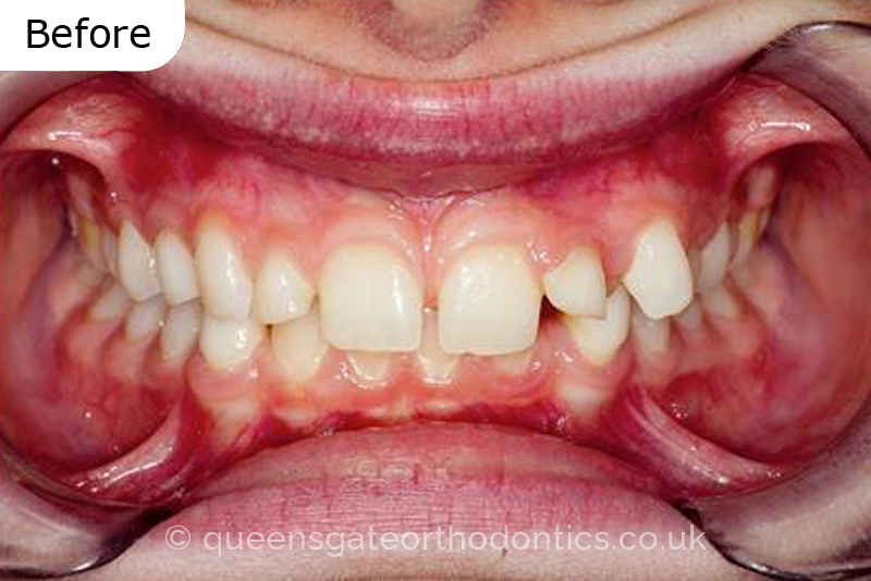 Correction of transposed, palatally impacted upper adult canines and lingually displaced lower canines, class II malocclusion (non – extraction)