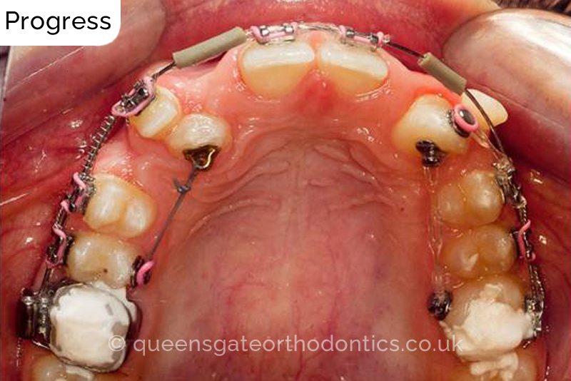 Correction of transposed, palatally impacted upper adult canines and lingually displaced lower canines, class II malocclusion (non – extraction)