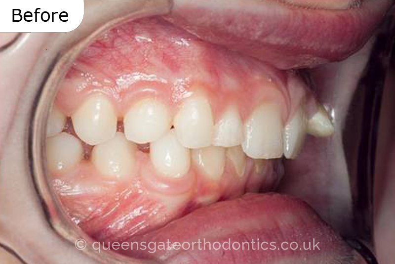 Correction of transposed, palatally impacted upper adult canines and lingually displaced lower canines, class II malocclusion (non – extraction)