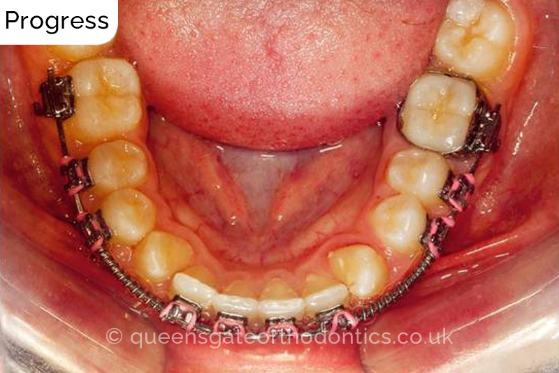 Correction of transposed, palatally impacted upper adult canines and lingually displaced lower canines, class II malocclusion (non – extraction)