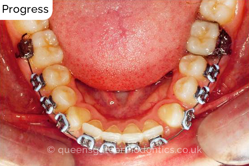 Correction of transposed, palatally impacted upper adult canines and lingually displaced lower canines, class II malocclusion (non – extraction)